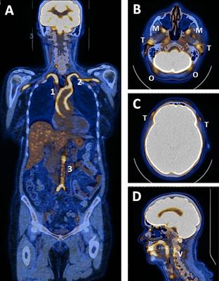 An overview of 18F-fluorodeoxyglucose positron emission tomography/computed tomography in giant cell arteritis